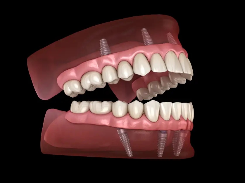 All-on-X Dental Implants
