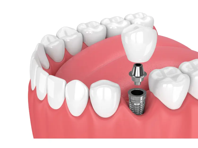 Dental Implant Restoration