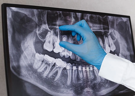 Digital X-Rays