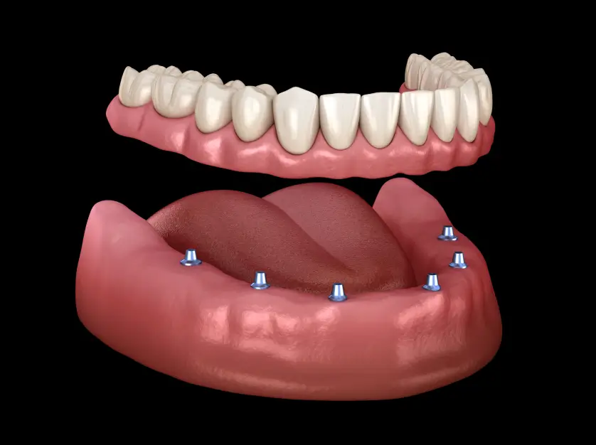 Implant-Supported Dentures in Kokomo, IN