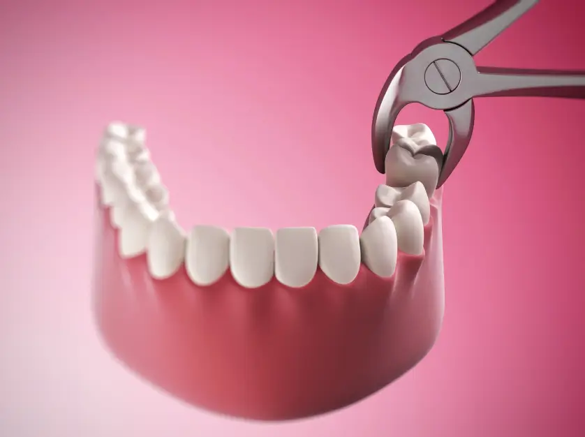 Tooth Extractions